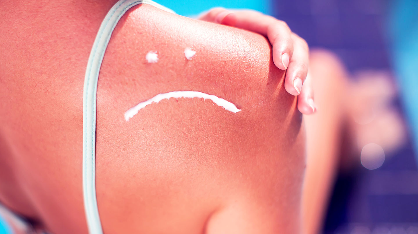 Schnelle Hilfe bei Sonnenbrand Schnelle Hilfe bei Sonnenbrand