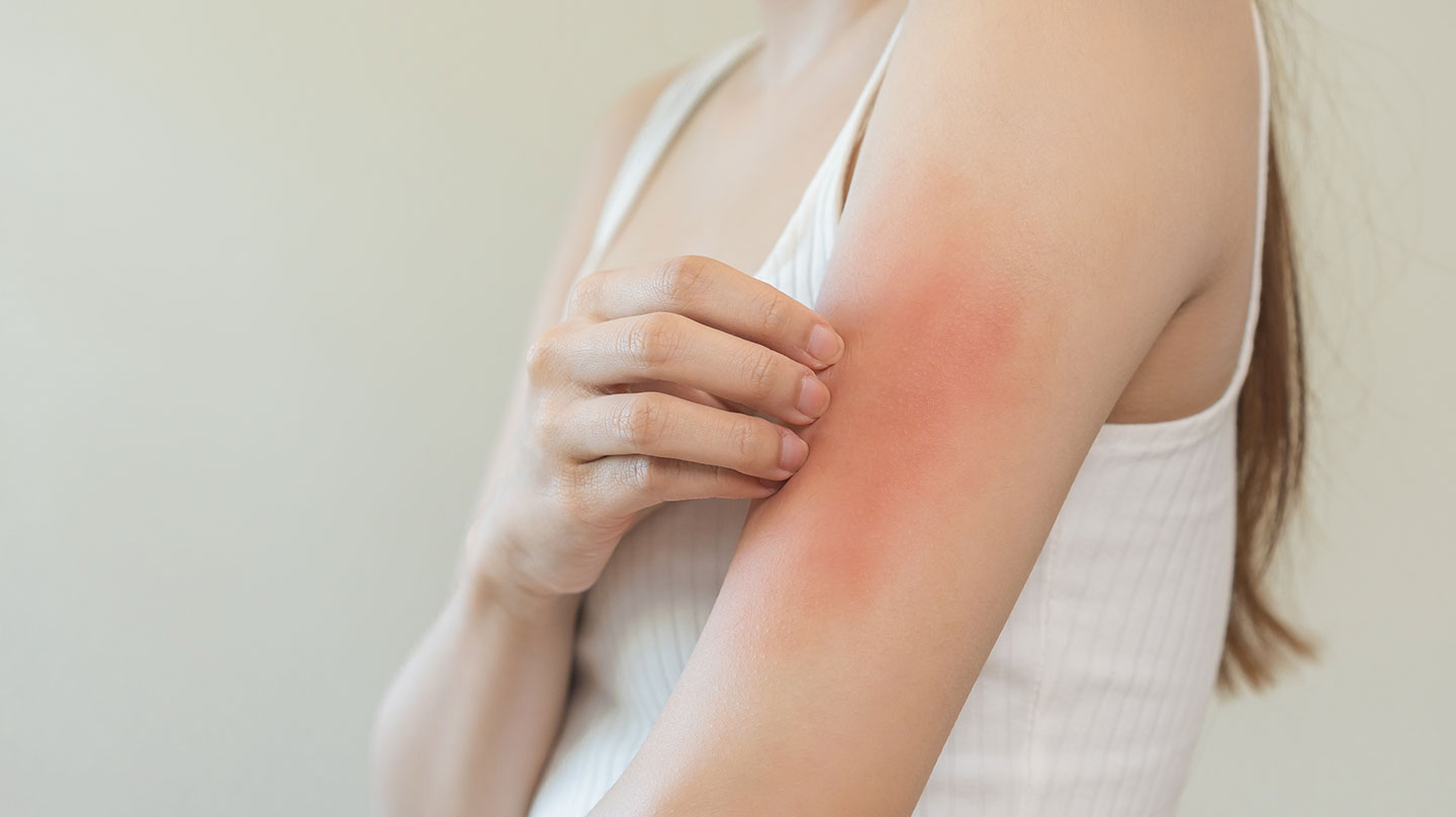 Vorsicht Zeckenstich – so erkennen Sie Borreliose Borreliose erkennen